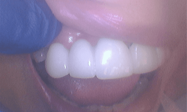 Restored teeth and smile