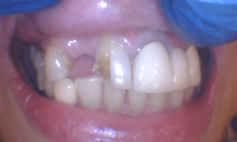Fractured teeth